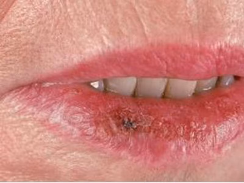 Đặc biệt, những người có thói quen sử dụng thuốc lá, nghiện rượu, có người thân từng mắc ung thư môi nếu trong khoang miệng xuất hiện các bản vá lỗi màu đỏ, trắng, sờ vào thấy tê cứng và kéo dài trong thời gian dài thì rất có thể đây là triệu chứng của căn bệnh nguy hiểm.