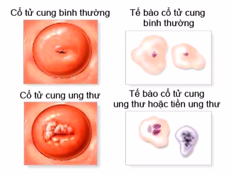 Tiến hành kiểm tra xem có xuất hiện khối u nào hay không. Những khối u này sờ vào đôi khi không mang lại cảm giác đau đớn, xung quanh được bảo vệ bởi lớp màng cứng.