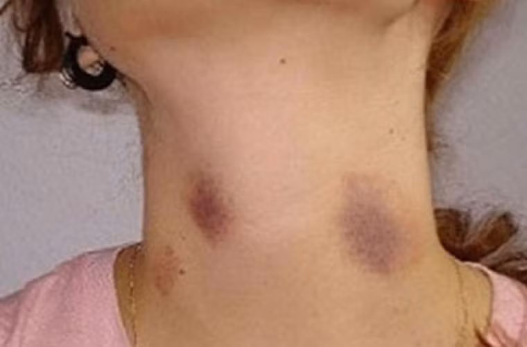 Xuất hiện vết sưng, bầm tím bất thường. Trong quá trình vui chơi bé dễ bị ngã, gây nên các vết bầm tím. Chính vì vậy, bạn cần để mắt đến con cái mới có thể phát hiện được dấu hiệu này.