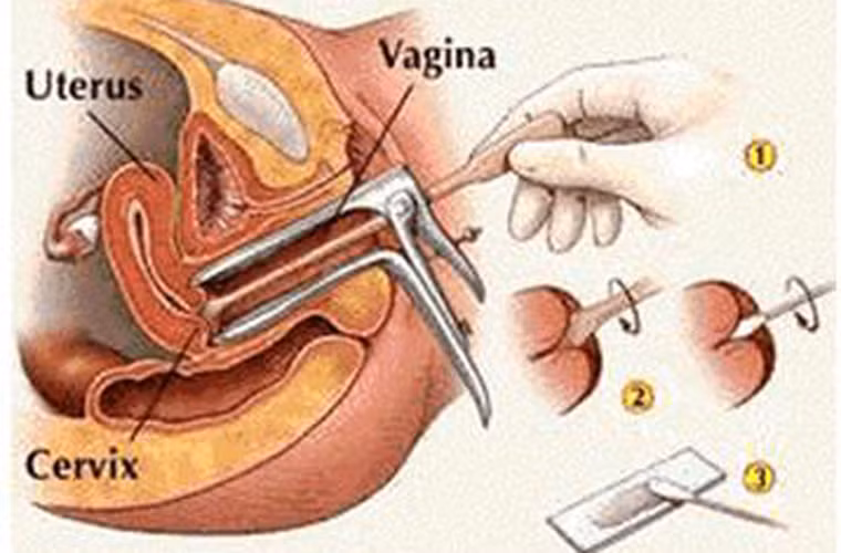 Khi thực hiện xét nghiệm Pap, bác sĩ sẽ dùng một dụng cụ chuyên khoa cào nhẹ một lượng tế bào ở cổ tử cung và âm đạo. Những tế bào này được dùng để kiểm tra dưới kính hiển vi; tìm hiểu xem có sự bất thường nào không.
