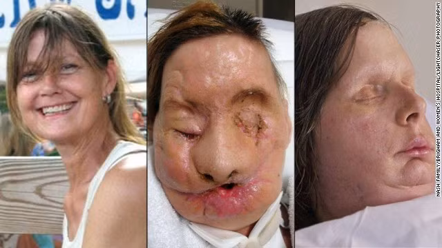 Charla Nash ở Stamford, Connecticut, Mỹ đã bị con tinh tinh nặng hơn 90kg vồ vào mặt khiến mặt và hai bàn tay của cô thương nghiêm trọng, mất hoàn toàn thị lực.