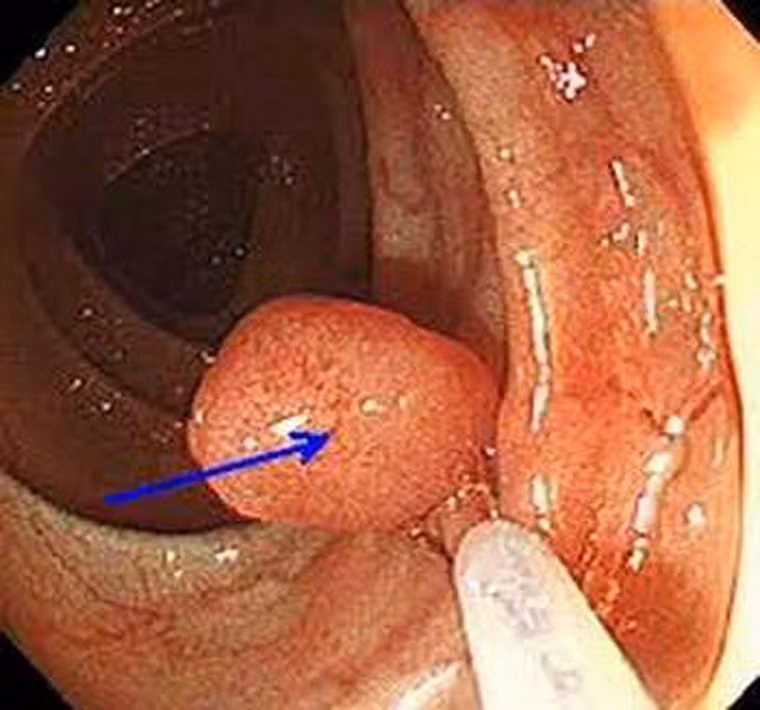 Ngoài tác dụng ngăn ngừa ung thư vú, The American Journal of Clinical Nutrition cho biết, phụ nữ ăn cá, cua 3 lần một tuần còn hạn chế được 33% khả năng xuất hiện polyp đại tràng so với người không tiêu thụ nhiều hải sản.