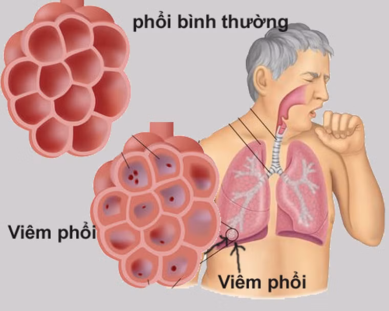 Ngoài ra, người bệnh do hút thuốc hoặc không đều có biểu hiện ho dai dẳng, khàn tiếng, viêm phế quản hoặc viêm phổi thường xuyên diễn ra.