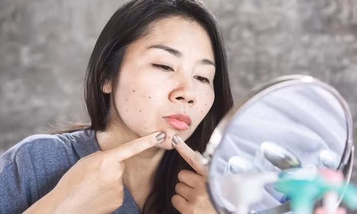 7 thói quen khiến bạn dù đã qua tuổi dậy thì mà mặt vẫn đầy mụn - Hình 2 7 thoi quen khien ban du da qua tuoi day thi ma mat van day mun-Hinh-2