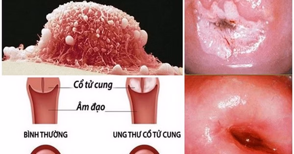 Yeu tu nam 16 tuoi khien co gai mac ung thu co tu cung