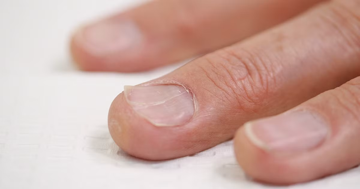  Móng tay giòn hoặc có hình thìa: Thông thường, dấu hiệu đầu tiên khi cơ thể thiếu sắt là móng tay giòn, dễ nứt và gãy. Trong giai đoạn sau của tình trạng thiếu sắt, phần giữa móng bị lõm xuống và các cạnh cong lên, tạo ra hình dạng như chiếc thìa. Ảnh: Pinterest.