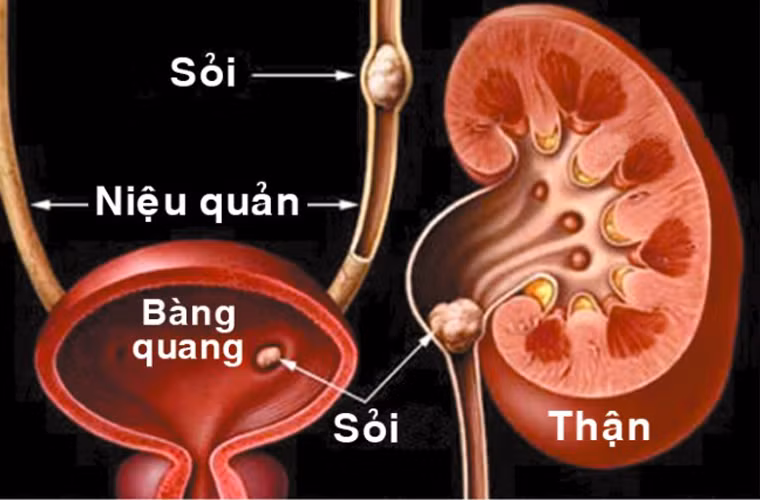 Bên cạnh đó, uống bia cũng có tác dụng lợi tiểu và làm giãn đường tiết niệu. Nhờ vậy, việc đào thải những hòn sỏi nhỏ trở nên dễ dàng và không gây đau đớn cho khổ chủ.