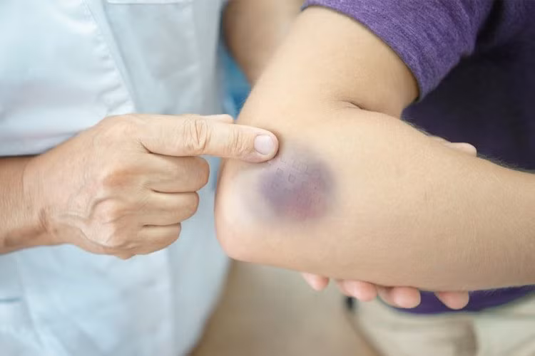 Không té ngã hay va đập, đột nhiên xuất hiện vết bầm tím trên da - Hình 2 Khong te nga hay va dap, dot nhien xuat hien vet bam tim tren da-Hinh-2