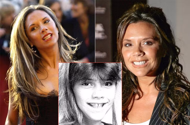 Khi còn nhỏ hàm răng của Victoria Beckham vừa to vừa thưa, cô đã phải gặp bác sĩ nha khoa nhiều lần mới có được hàm răng trắng, đều như hiện tại.