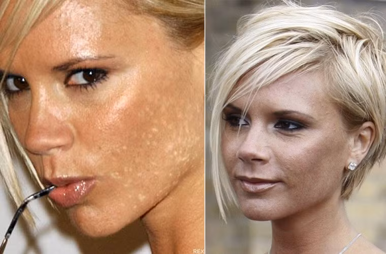 Từng có thời Victoria Beckham phải khổ sở với làn da vừa nổi mụn vừa bị loang lổ đen trắng như thế này.