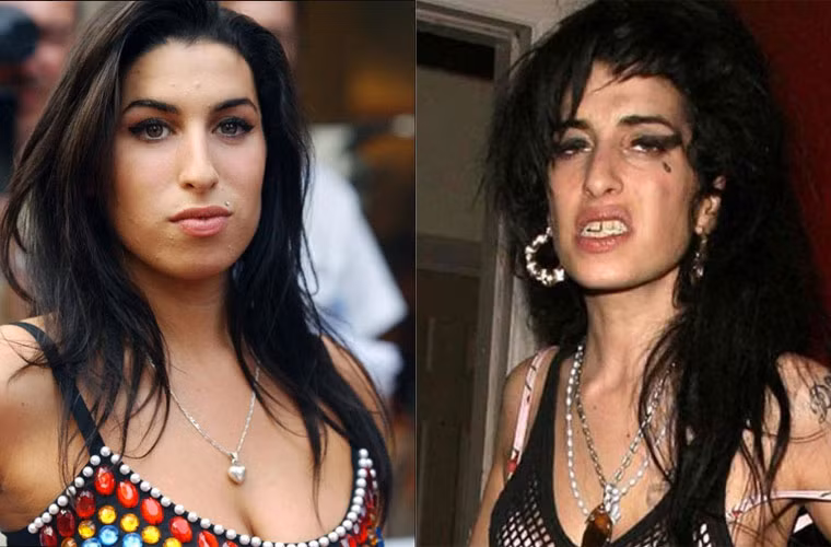 Họa mi Anh quốc Amy Winehouse nghiện nặng tới mức cô phải dùng hỗn hợp cocaine, ecstasy, ketamine, heroin và rượu mới đủ đô. Thói nghiện đã khiến khắp người cô lúc nào cũng đầy vết thâm tím. Năm 2011, Amy qua đời vì ngộ độc rượu.