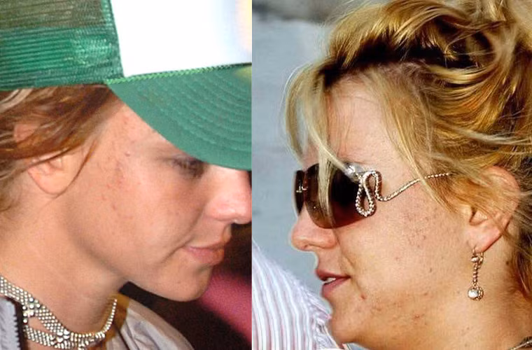Britney Spears bị già hơn so với tuổi 32 vì làn da xấu xí.