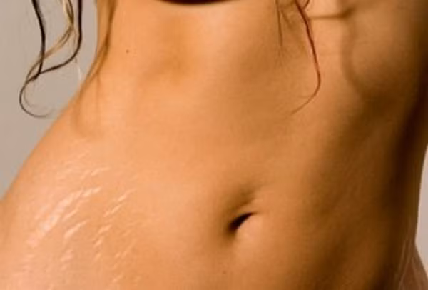 Rạn da là không có cách nào ngụy trang. Rất nhiều bạn gái phải từ bỏ những bộ trang phục yêu thích của mình vì những vết rạn da xấu xí. Điều này sẽ chẳng còn là nỗi ám ảnh của bạn vì bạn hoàn toàn có thể ngụy trang cho chúng. Kem làm nâu da (cả dạng lotion và dạng xịt), sản phẩm này tỏ ra rất hiệu quả trong việc che đậy các vết rạn da. Nhiều hãng mỹ phẩm đã chế tạo ra các sản phẩm kem nền toàn thân, chúng cũng che phủ rất hoàn hảo.