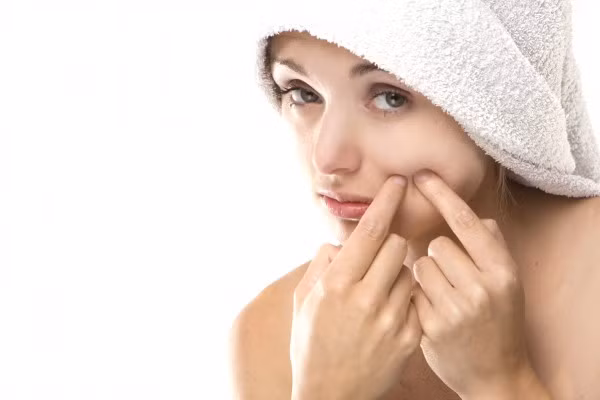 Nặn mụn. Không bao giờ nặn, chèn ép mụn vì nó rất dể để lại sẹo trên khuôn mặt bạn. Nó cũng có thể làm phát tán mụn để những chổ khác trên mặt bạn.