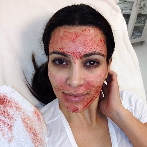 Làm đẹp bằng liệu pháp máu ma cà rồng. Những nhân vật nổi tiếng như Kim Kardashian, Dannii Minogue và Anna Friel đã từng thử làm đẹp với phương pháp kinh dị này. Máu được lấy từ cánh tay, sau đó trải qua quá trình phân tách tế bào và bơm trở lại vào mặt của bạn. Mỗi lần điều trị này có giá khoảng 600 Pound (khoảng 22 triệu VNĐ).
