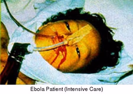 Dịch Ebola năm 1995. Năm 1995, tại Cộng hòa Dân chủ Congo cũng đã xảy ra một trận dịch Ebola làm hơn 200 người thiệt mạng. Nơi xảy ra dịch là ở Kikwit, cách nơi xảy ra trận dịch năm 2014 khoảng 400km về phía Tây.