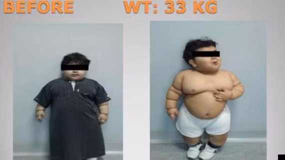 Cậu bé 2 tuổi trước khi phẫu thuật giảm cân.