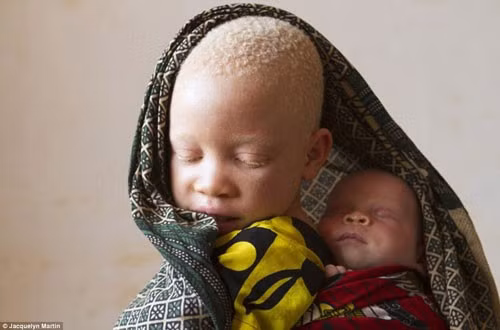 Hiện tượng kì thị này khá phổ biến không chỉ ở Tanzania nói riêng mà còn ở các quốc gia châu Phi khác nữa. Với quan niệm mù quáng rằng những người bị bạch tạng tiềm ẩn ma thuật và có khả năng đem lại may mắn, các phù thủy thường bảo những ma cô đi lấy các bộ phận trên cơ thể họ để làm thuốc chữa bệnh hay bùa chú. Một vài người trong số họ thậm chí còn tưởng, nhờ các bộ phận trên người bạch tạng đó, con người còn trở nên vô hình.