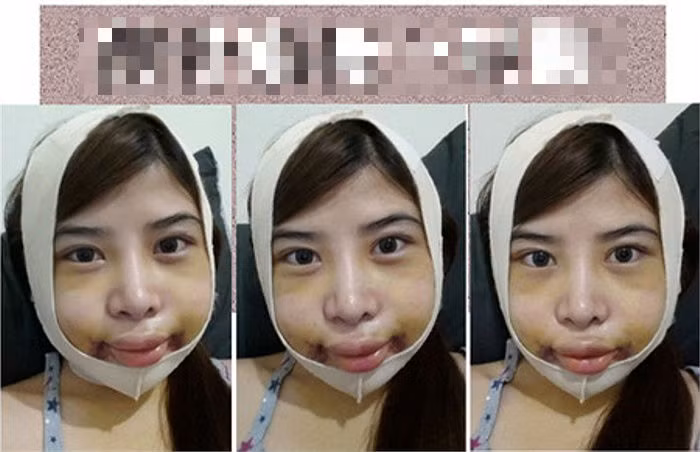 1 tuần sau phẫu thuật, cô vẫn phải cố định khuôn mặt bằng băng cuốn.