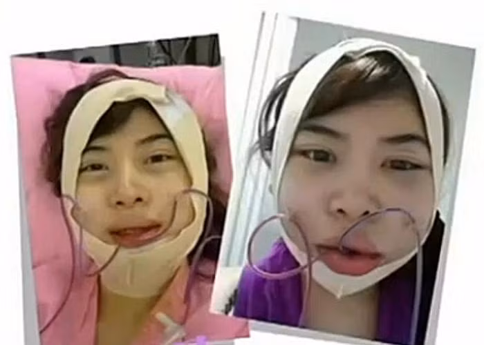 Khuôn mặt sưng vù lên sau các thủ thuật phẫu thuật thẩm mỹ.