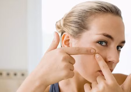 Chỉ có thể “giải quyết” bằng cách nặn. Nặn mụn, hút mụn.... chỉ có thể làm cho bạn “an tâm” được vài ngày, bởi vì những biện pháp đó đều là tạm thời, không bao lâu sau thì mụn lại “nổi” lên ở ngay chỗ cũ bạn vừa nặn. Nặn mụn sẽ làm cho chúng nhiễm trùng, lây lan và thậm chí để lại sẹo.