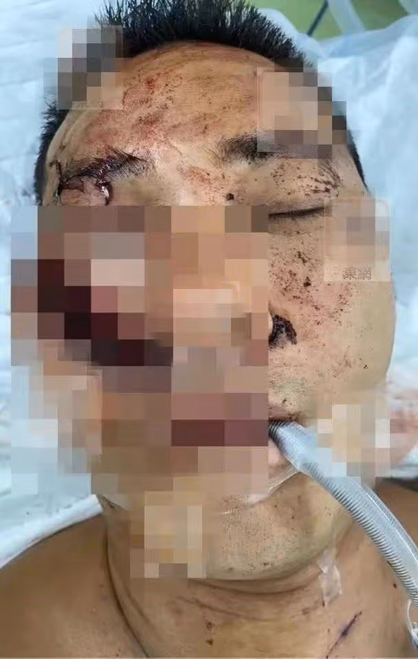 Diễn viên Hoàng Tuấn Phong bị chém 3 nhát vào mặt, bất tỉnh tại chỗ Dien vien Hoang Tuan Phong bi chem 3 nhat vao mat, bat tinh tai cho
