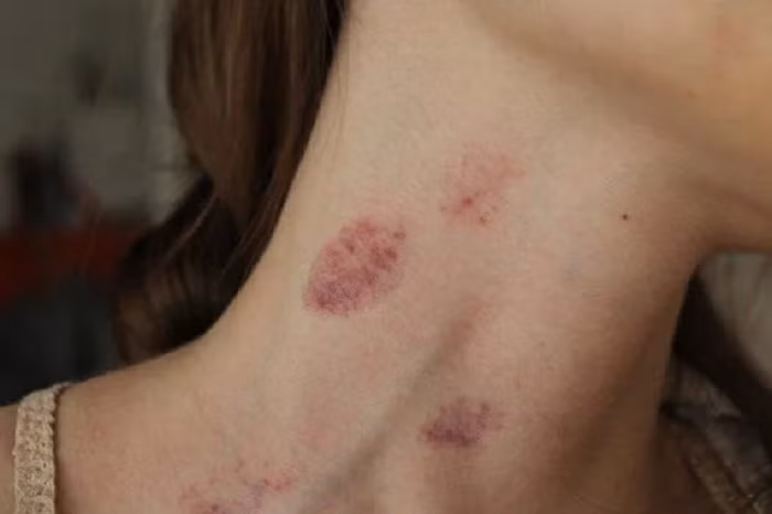 Thấy trên người vợ có dấu răng sau khi đi du lịch, chồng có quyết định bất ngờ - Hình 3 Thay tren nguoi vo co dau rang sau khi di du lich, chong co quyet dinh bat ngo-Hinh-3