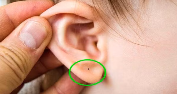 Trẻ có 1 trong 6 nốt ruồi này là phước báu, tương lai sáng như ngọc - Hình 2 Tre co 1 trong 6 not ruoi nay la phuoc bau, tuong lai sang nhu ngoc-Hinh-2