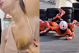 Gặp tai nạn khi lái mô-tô, gái xinh khiến fan xót xa