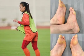Hot girl bóng đá Hoàng Thị Loan gây xôn xao với bàn chân biến dạng