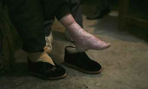 Đôi chân gãy gập đau đớn của những phụ nữ bó chân