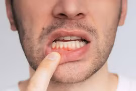 Kẹo dẻo lợi khuẩn giúp giảm chảy máu chân răng chỉ sau 6 tuần