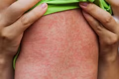 WHO kêu gọi hành động khẩn cấp ứng phó bệnh sởi