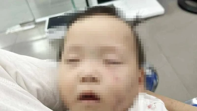 Bắc Ninh xác minh bé gái 1 tuổi bị bầm tím mặt khi đi học