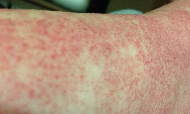 Sốt xuất huyết Dengue không phải lúc nào cũng biểu hiện bằng sốt cao hay xuất huyết - Ảnh minh họa Sốt xuất huyết Dengue không phải lúc nào cũng biểu hiện bằng sốt cao hay xuất huyết - Ảnh minh họa