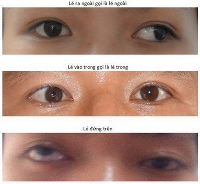 Lác mắt ở trẻ em ngày càng tăng/Ảnh SKĐS 1-5432.jpg