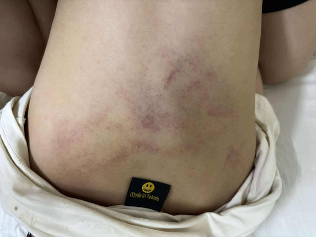 Hình ảnh bé gái bị đánh thâm tím phần mông. Ảnh: Gia đình nạn nhân cung cấp. 2-3852.jpg