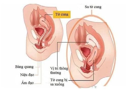 Sa tử cung có thể bắt nguồn từ nhiều nguyên nhân Sa tử cung có thể bắt nguồn từ nhiều nguyên nhân