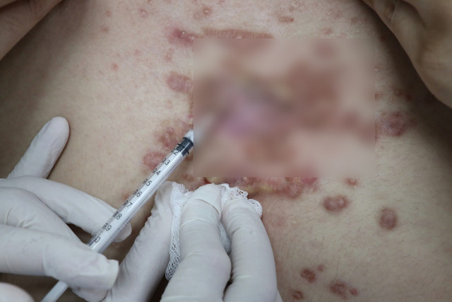 Bệnh viện Da Liễu TP HCM thường xuyên tiếp nhận người bệnh bị biến chứng khi làm đẹp ở cơ sở không uy tín. Ảnh: BV Bệnh viện Da Liễu TP HCM thường xuyên tiếp nhận người bệnh bị biến chứng khi làm đẹp ở cơ sở không uy tín. Ảnh: BV
