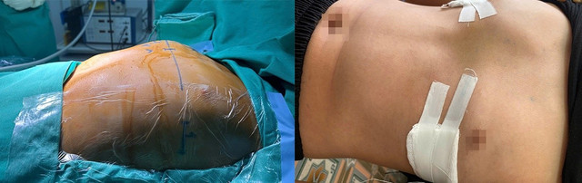 Hình ảnh ngực của bệnh nhi L.T.P.Đ, 12 tuổi, trước (nhô như ức gà) và sau phẫu thuật (ngực bằng phẳng- bên phải)/benhviendakhoatinhphutho.vn 1-8788.jpg