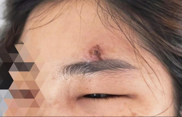Các bác sĩ chẩn đoán chị L. bị viêm mô bào dưới da vùng mặt. Ảnh: BVCC. Các bác sĩ chẩn đoán chị L. bị viêm mô bào dưới da vùng mặt. Ảnh: BVCC.