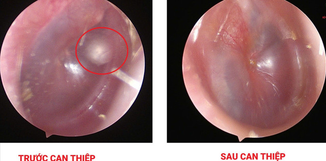 Hình ảnh trước và sau can thiệp/ Ảnh Bệnh viện Sản Nhi Quảng Ninh 557211289-1243114104525059-3040435931013983105-n-scaled-3927.jpg