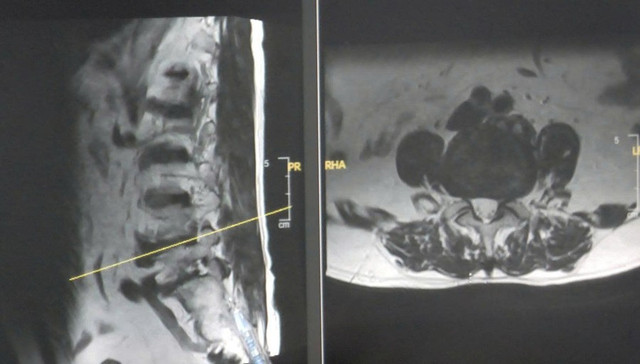 Hình ảnh MRI thoát vị đĩa đệm của bệnh nhân. (Ảnh: BVCC) Hình ảnh MRI thoát vị đĩa đệm của bệnh nhân. (Ảnh: BVCC)