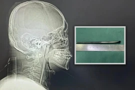 Chuyện hy hữu, 8 năm sống chung với chiếc đũa trong cổ họng