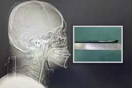 Chuyện hy hữu, 8 năm sống chung với chiếc đũa trong cổ họng