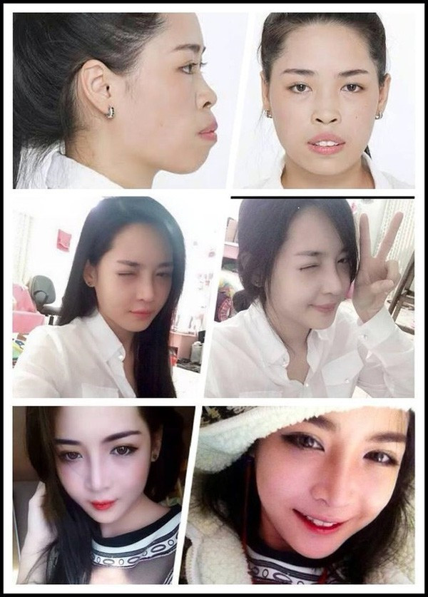 Vũ Thanh Quỳnh, cô gái sinh năm 1992 có lẽ là một trong những trường hợp thay đổi cuộc đời ấn tượng nhất nhờ PTTM. Xuất thân từ vùng quê Nam Định, Quỳnh từng không thể xin được việc làm vì xấu xí nhưng sau khi lột xác thì đã khiến nhiều người không khỏi ngỡ ngàng.