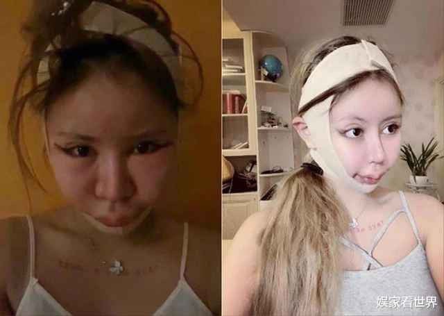 Khi đã can thiệp dao kéo hầu hết phần mặt, Zhou Chuna đổi sang nâng ngực, hút mỡ, bơm mông để có vóc dáng quyến rũ, gợi cảm. Thậm chí, cô gái sinh năm 2005 còn quyết định đi kéo chân để có được chiều cao như ý.