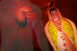 Liệu pháp điều trị DNA giúp giảm một nửa cholesterol xấu