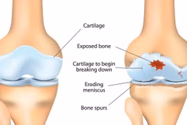 Phát hiện thuốc chống động kinh có thể giúp phục hồi sụn khớp