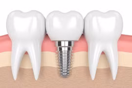 Hạt titan từ răng implant có thể kích hoạt viêm kéo dài